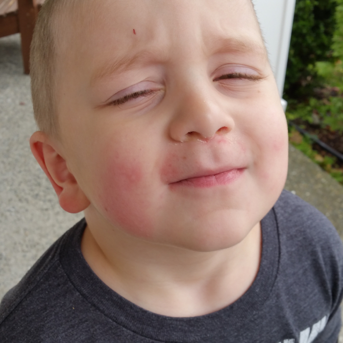 More Food Allergies To Deal With